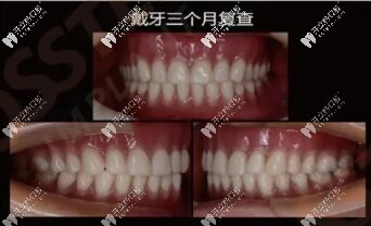 全口桿卡式半固定種植牙