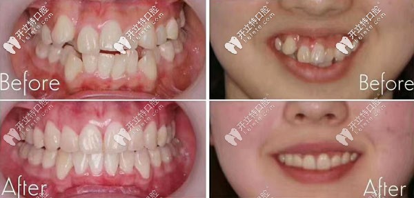 呦!上/下牙齒擁擠錯(cuò)位不齊的拔牙矯正效果還不錯(cuò)嘛