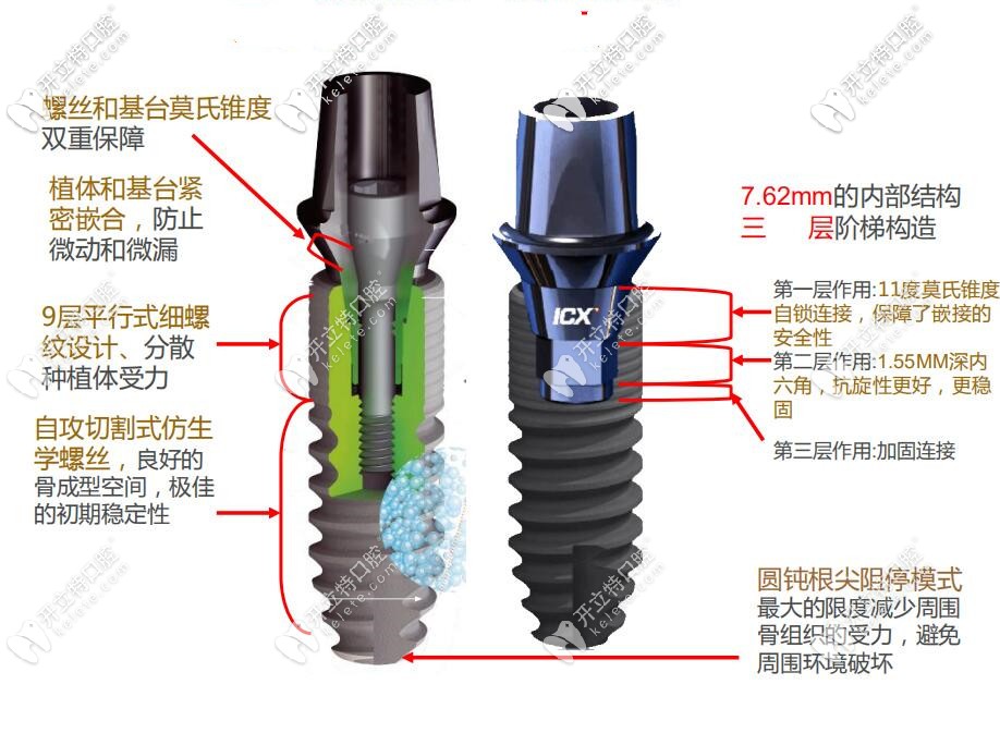 icx種植系統(tǒng)特點