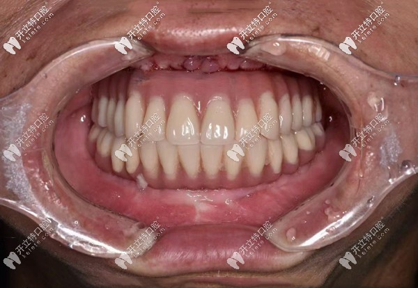 深圳爾睦口腔全口種植牙效果 深圳爾睦口腔全口種植牙效果