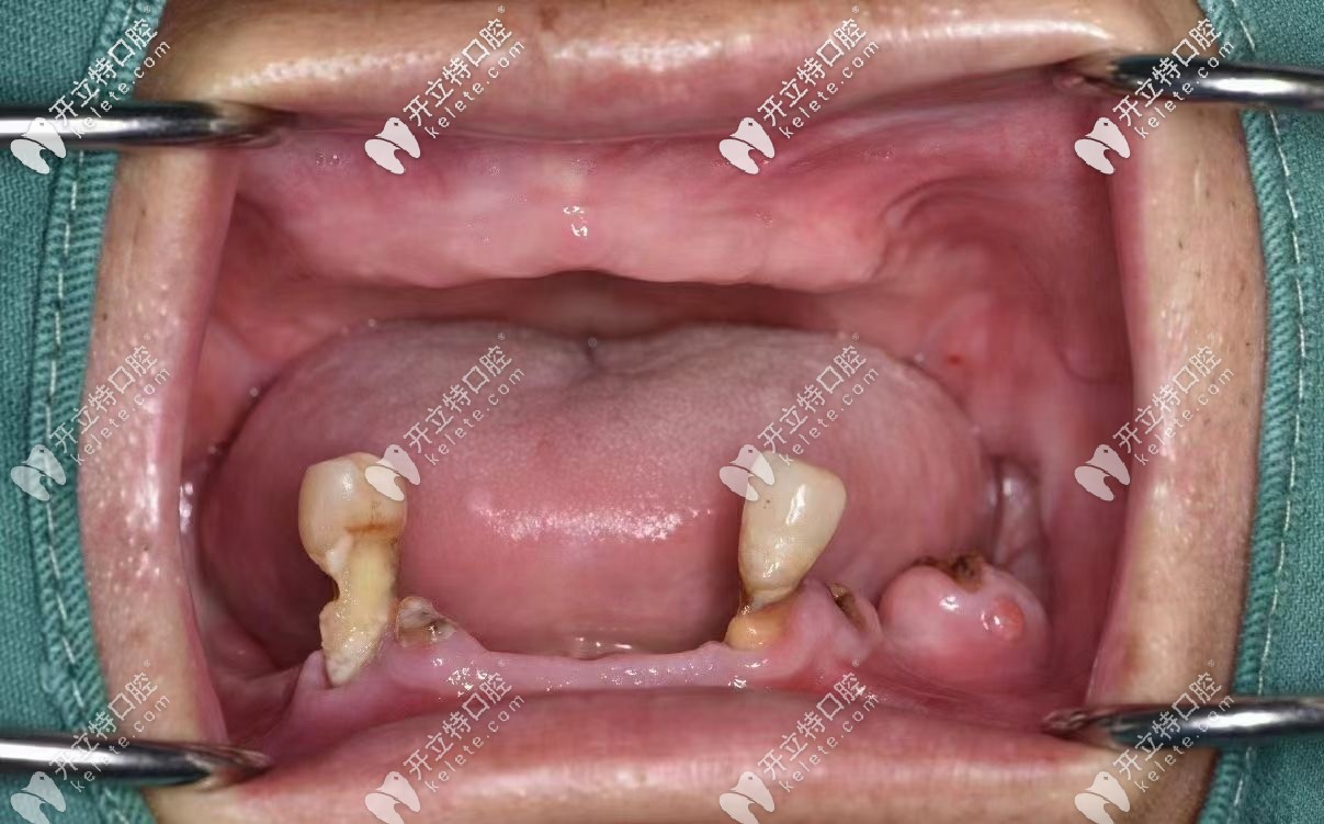 來評(píng)價(jià)下深圳爾睦口腔剛做的allon4全口種植牙怎么樣吧