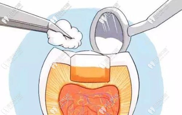 進(jìn)口3M樹脂補(bǔ)牙