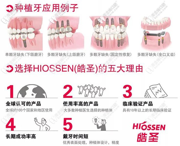 皓圣ETIII SA種植體，支持延期種植又擅于即刻種植