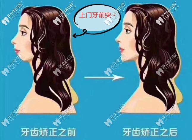 上門牙前突牙齒矯正多少錢?正畸方法不同價(jià)格也是有差別的