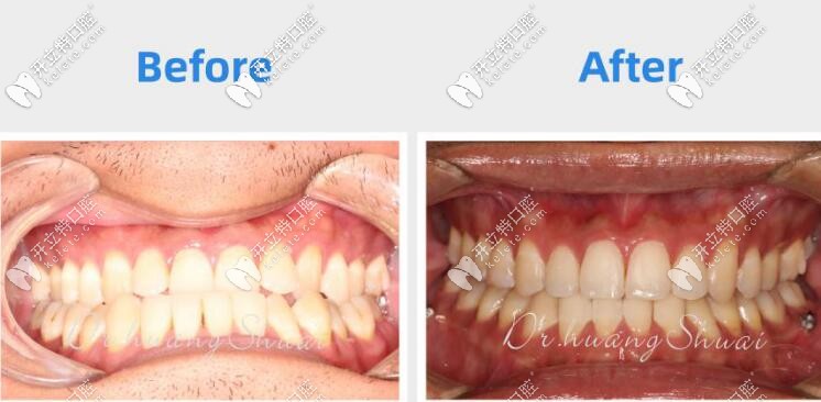 骨性地包天矯正后牙齒變化圖 骨性地包天矯正后牙齒變化圖