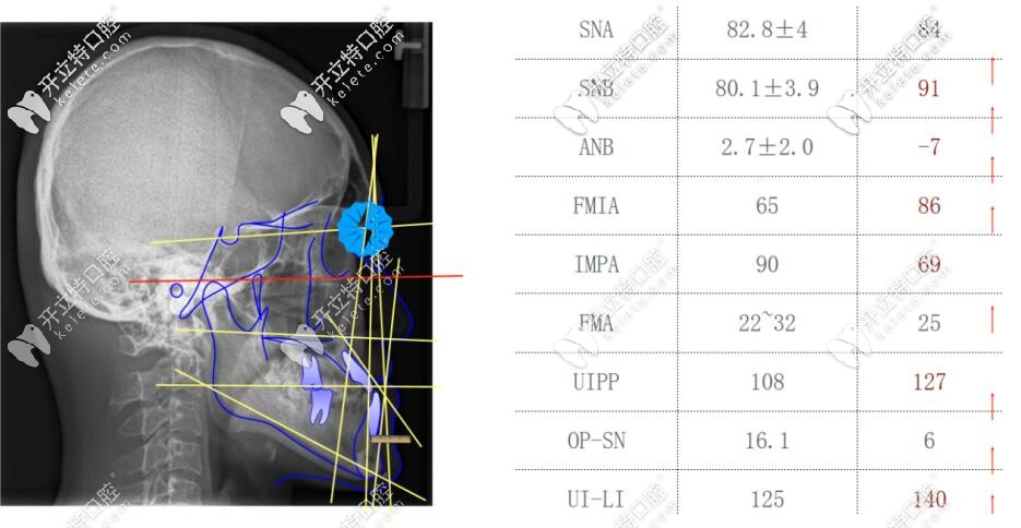 骨性地包天檢查后頭顱各項數(shù)據(jù) 骨性地包天檢查后頭顱各項數(shù)據(jù)