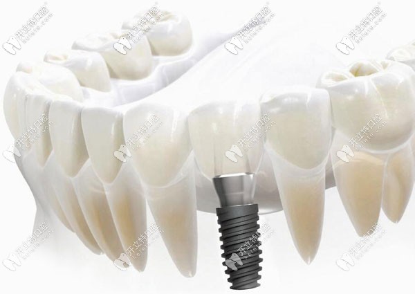 天河區(qū)做歐美種植牙的價格 天河區(qū)做歐美種植牙的價格