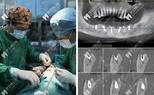 只需5顆種植體就能恢復半口牙齒