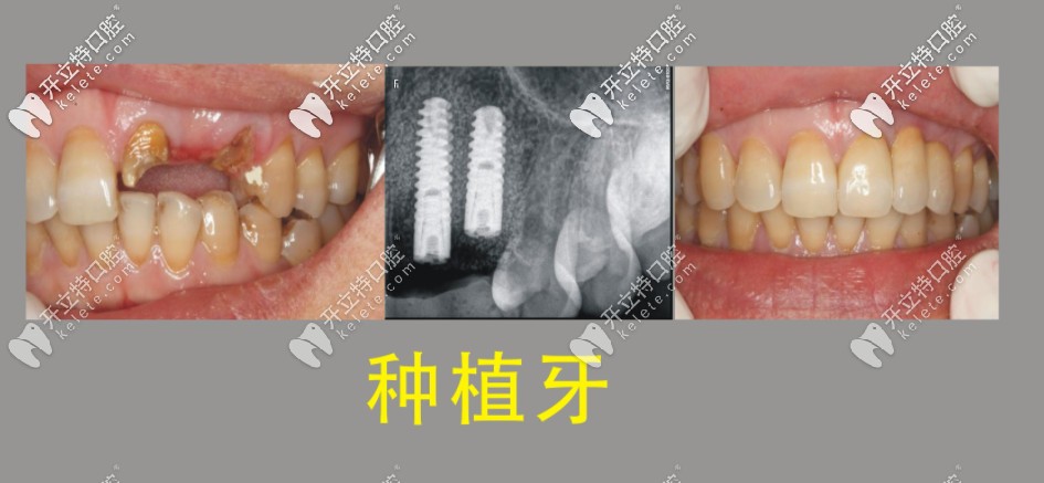 種植牙前后對(duì)比