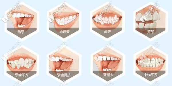 牙齒矯正的類型