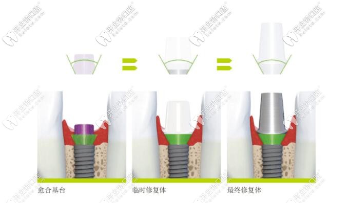 骨水平種植體植入示意圖↓