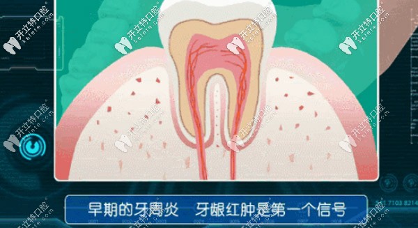 早期牙周炎，牙齦紅腫是個信號