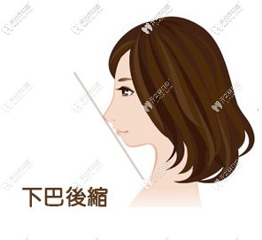 誰(shuí)知道齙牙矯正后能改善齒性齙牙下巴后縮嗎？怎么矯正好