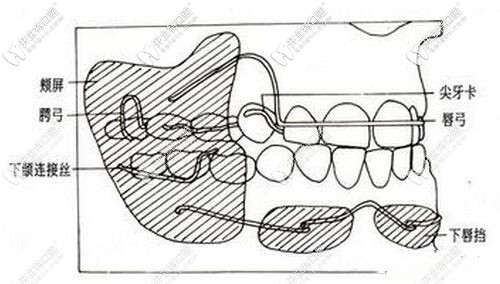 戴入附平面導(dǎo)板的上頜活動(dòng)矯治器
