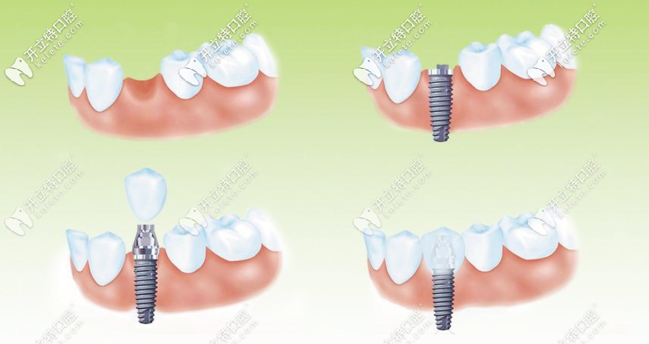 種植牙的過(guò)程
