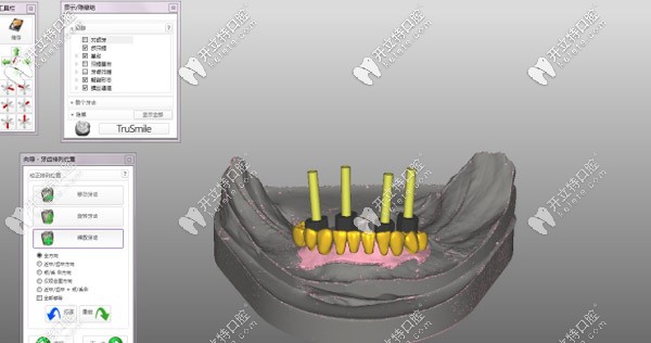 種植桿卡要先進(jìn)行CAD設(shè)計(jì)