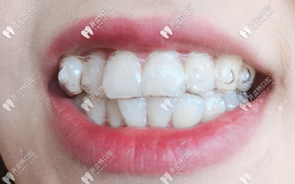 在廣州做國(guó)產(chǎn)或進(jìn)口隱形矯正的費(fèi)用