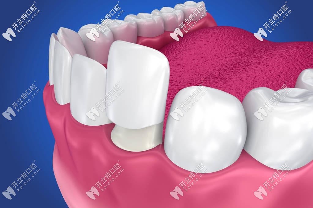 武漢做牙齒貼面技術(shù)比較好的醫(yī)院都在這了,還有瓷貼面價(jià)格