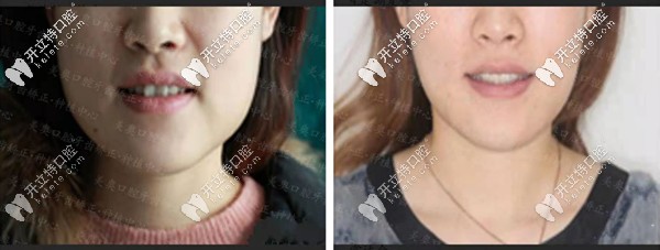 矯正前后對(duì)比圖二