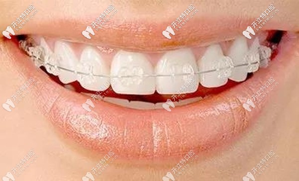陶瓷托槽半隱形矯正