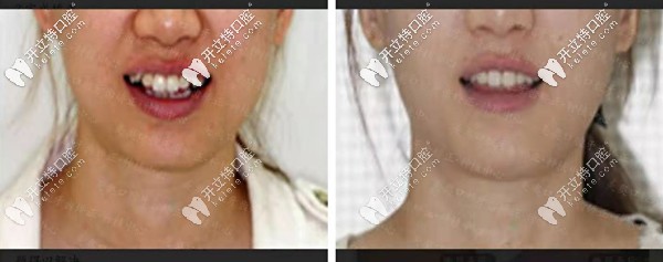 矯正前后對(duì)比圖一