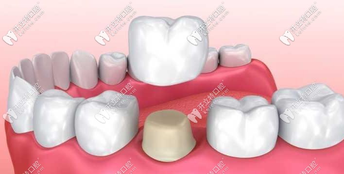 牙冠示意圖 牙冠示意圖
