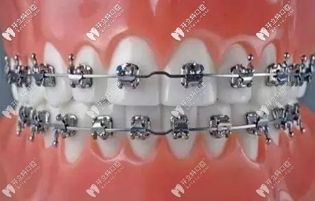 自鎖托槽矯正 自鎖托槽矯正