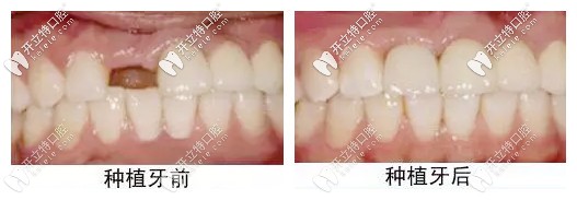 德柏口腔種牙前后對比