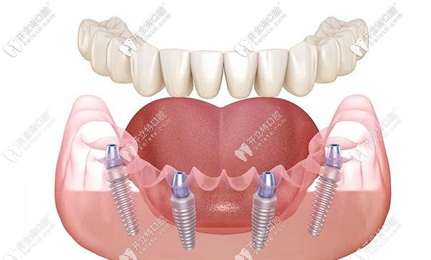 all-on-4種植技術(shù)