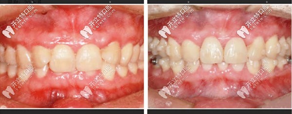 深覆合隱適美隱形矯正前后對比