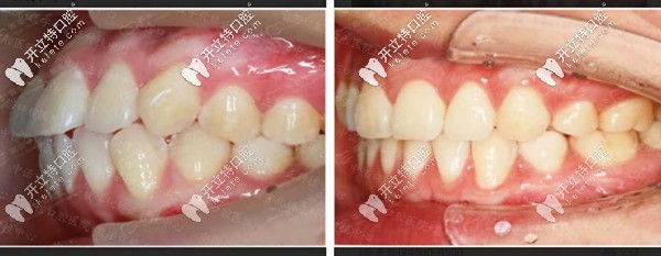 牙齒前凸時代天使隱形矯正前后對比