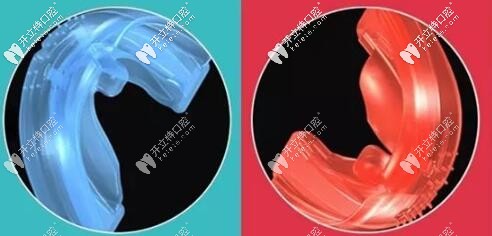 早期功能矯治器