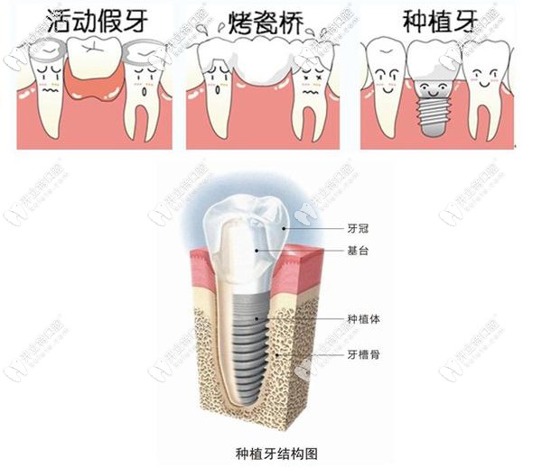 種植牙與活動假牙區(qū)別圖