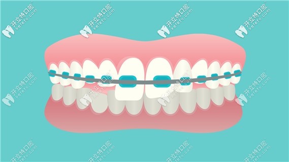 晉城牙齒矯正的費用參考