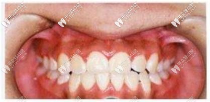 矯正后的牙齒變整齊了