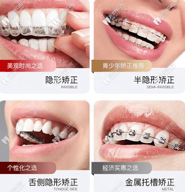 廊坊圣潔口腔的矯正技術 廊坊圣潔口腔的矯正技術