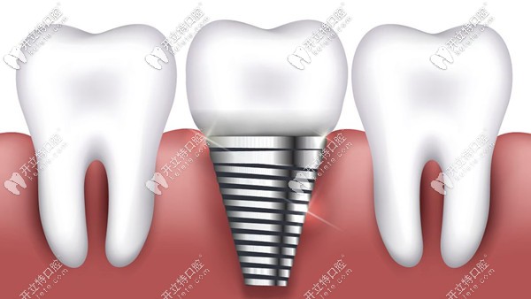 常德美奧口腔種植牙價格