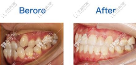 首<!--<i data=20240703-sp></i>-->張棟梁矯正案例對(duì)比