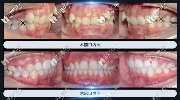 長(zhǎng)沙美奧口腔：熊安鳳醫(yī)生的復(fù)雜案例圖