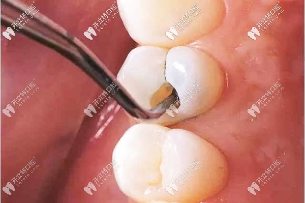 小黑點(diǎn)發(fā)展到中齲就需要補(bǔ)牙治療了