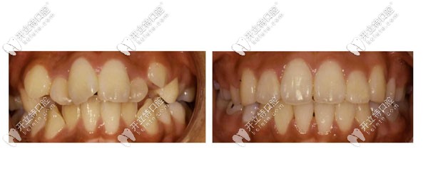 牙齒矯正<span style=