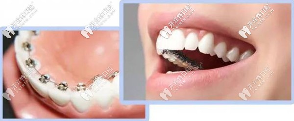 舌側隱形矯正