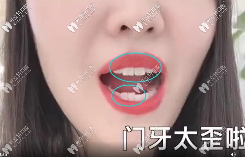 天津河東美萊矯正牙齒怎么樣 菇?jīng)龃麟[形牙套整牙視頻送上