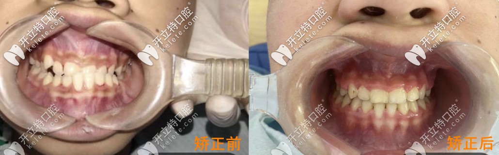 矯正牙齒前后對比