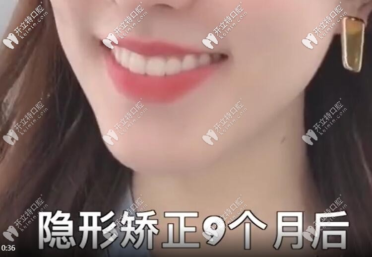 門(mén)牙不齊帶隱形牙套矯正9個(gè)月效果圖