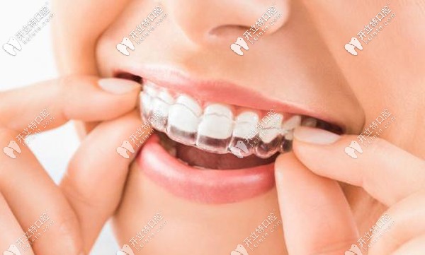 求鄭州口腔矯正牙齒的費用，隱適美箍牙價格一般多少錢