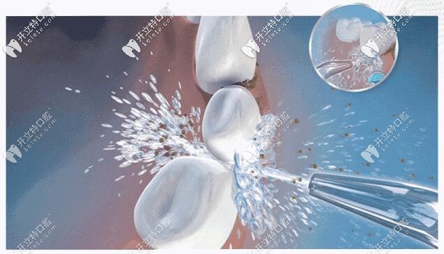 超聲波洗牙：有效清潔牙齒、保護(hù)牙齒健康