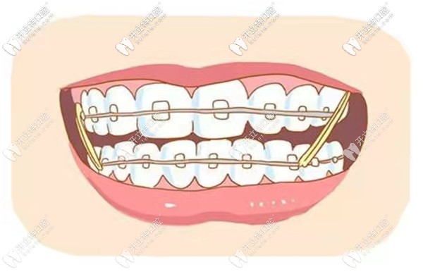 煙臺口腔醫(yī)院整牙做牙齒矯正收費多少錢