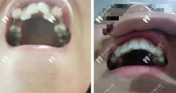 戴隱形牙套1年半的效果圖 戴隱形牙套1年半的效果圖