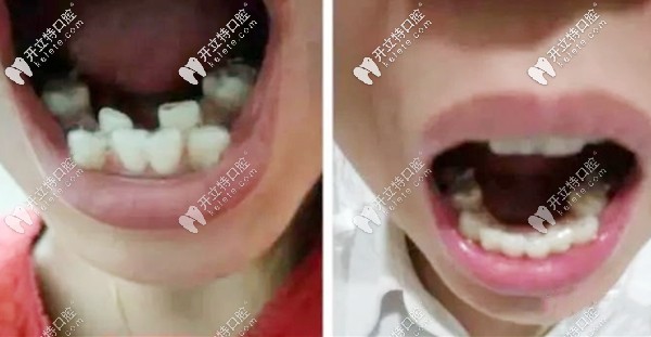 在朔州做隱形牙齒矯正的案例圖 在朔州做隱形牙齒矯正的案例圖